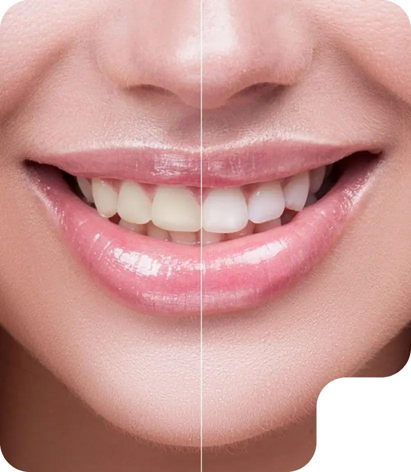 Blanqueamiento Dental
